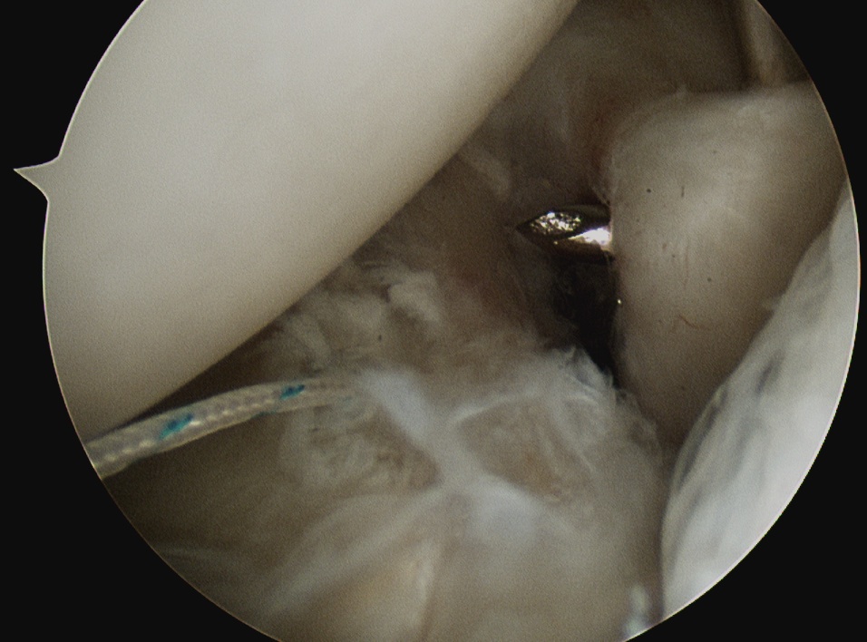 Shoulder Instability Capsular Plication